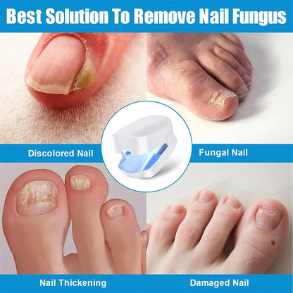 Nail Fungus Laser Treatment Device